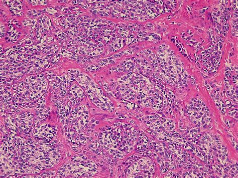 Clear Cell Sarcoma The Tumor Is Composed Of Nests Of Uniform