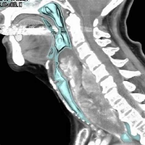 Segment of squamous papilloma of the esophagus showing finger-like ...