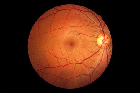 Fundus Photo Eye Patient