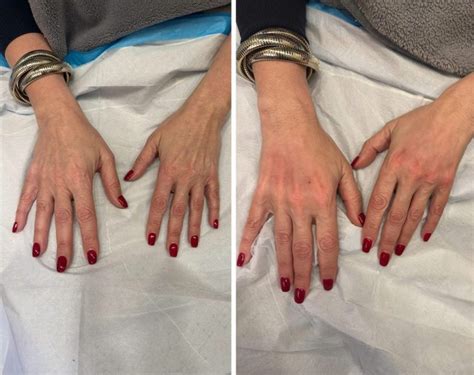 The Five Treatment Options To Combat Ozempic Hands Anna Avaliani MD