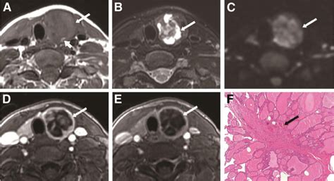 Diagnostic Efficacy Of Multiple Mri Parameters In Differentiating Benign Vs Malignant Thyroid