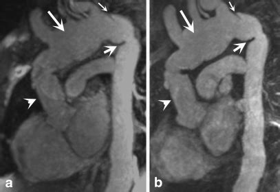 A 44 Year Old Female Patient With A History Of Type I Aortic Dissection