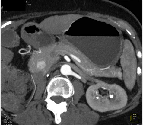 Metastatic Renal Cell Carcinoma To The Pancreas With Vascular