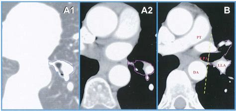 Figure 2 From CT Based Definition Of Thoracic Lymph Node Stations An