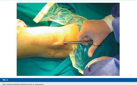 Figure From A New Treatment Strategy For Severe Arthrofibrosis Of The