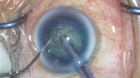 Phaco Horizontal And Vertical Chop In Grade 3 Cataract Youtube