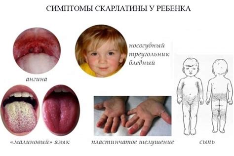 Скарлатина у ребенка Причины симптомы лечение профилактика скарлатины Здоровье детей