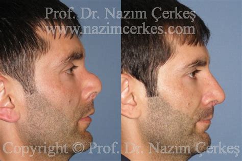 Revision Nose Surgery Rhinoplasty Before After Pictures Male