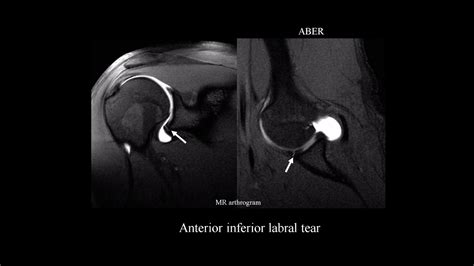 Mri Shoulder Labrum Pathology Youtube