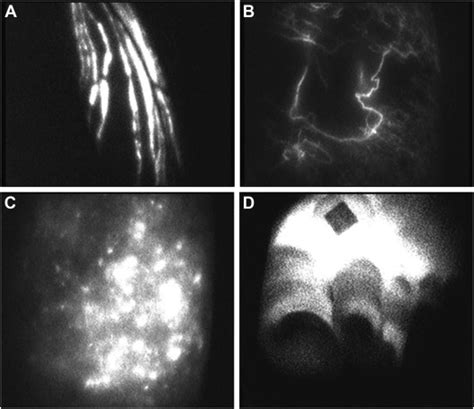 Surgical Treatment Of Lymphedema In The Upper Extremity Hand Clinics