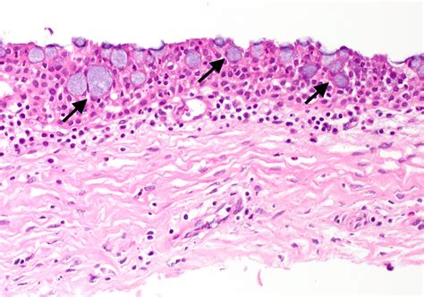 Goblet Cells Are Seen In The Corneal Epithelium Black Arrow Hande 20 ×