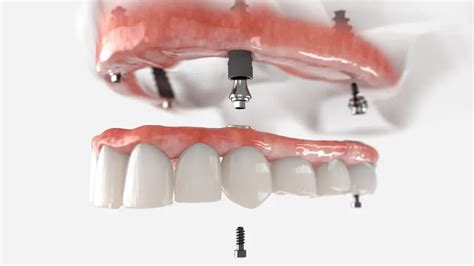 All-on-X Dental Implants | The Best Permanent Denture Solution