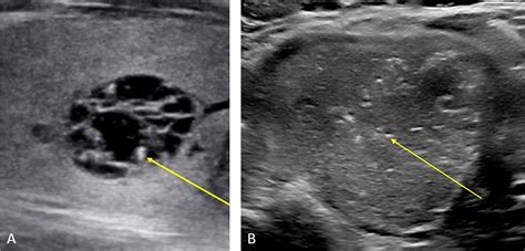 Thyroid Anatomy And Ultrasound Evaluation Techniques In Vascular