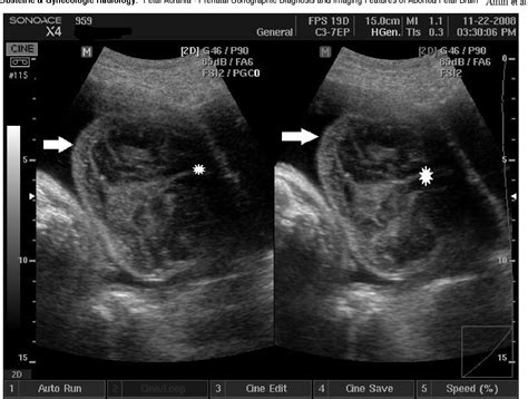 Figure 2 From Fetal Acrania Prenatal Sonographic Diagnosis And