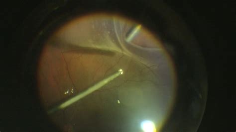 Rhegmatogenous Retinal Detachment Vitrectomy Youtube