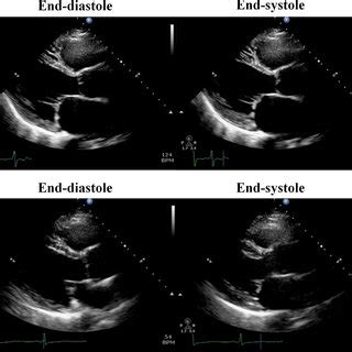 Fluoroscopic View Of The Pulmonary Vein Ablation Catheter Pvac With