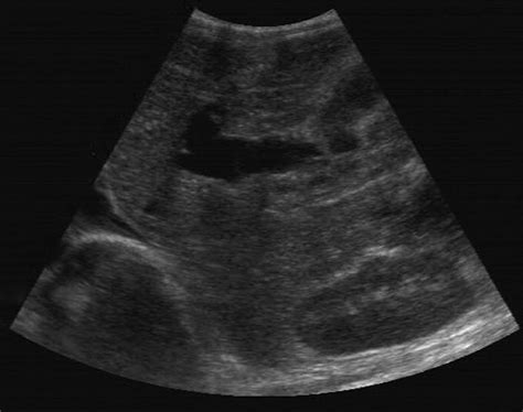 Clinical Value Of Ultrasound In Diagnosing Pediatric Choledochal Cyst Perforation Ajr