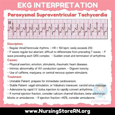 Untitled On Tumblr Paroxysmal Supraventricular Tachycardia Ekg Ecg