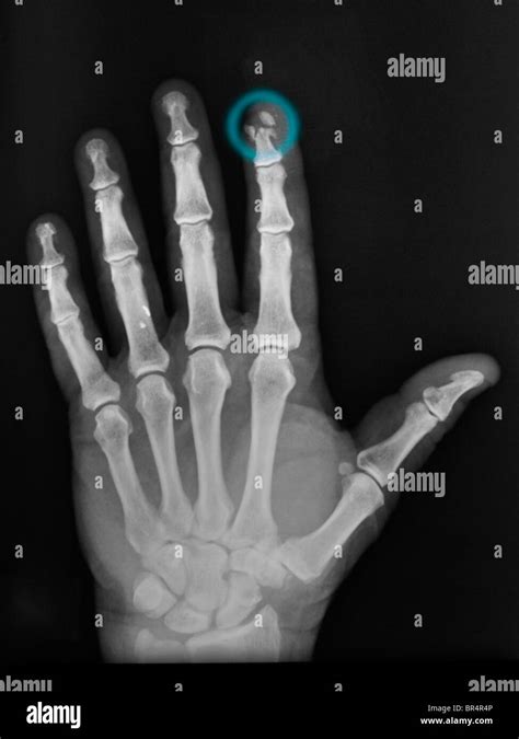 Broken Hand X Ray High Resolution Stock Photography and Images - Alamy