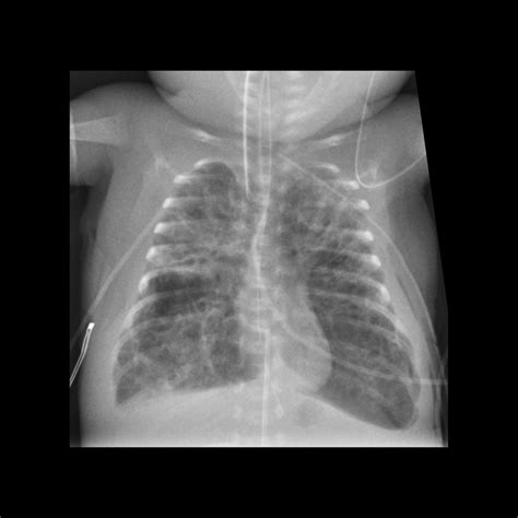 Respiratory Distress Syndrome Pediatric Radiology Reference Article