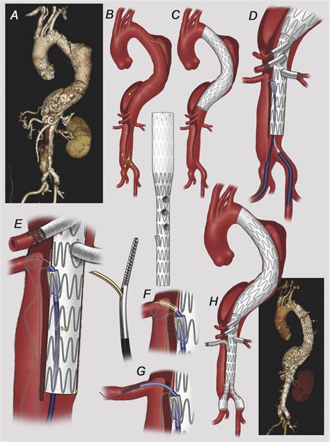 Vess Outcomes Of Endovascular Repair Of Postdissection And