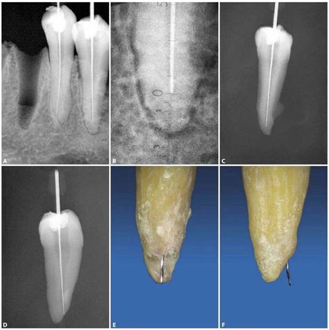 Apex locator #endodontics #obturation | Endodoncia, Odontología, Salud ...