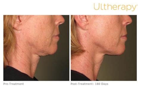 Ultherapy Before And After Photos Mulberry House Clinic