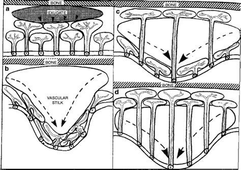 Pathogenesis And Pathophysiology Of Nasal Polyps Springerlink