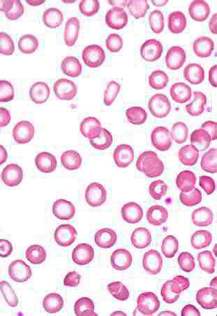 Microcytic Anemia Facts Flashcards Quizlet