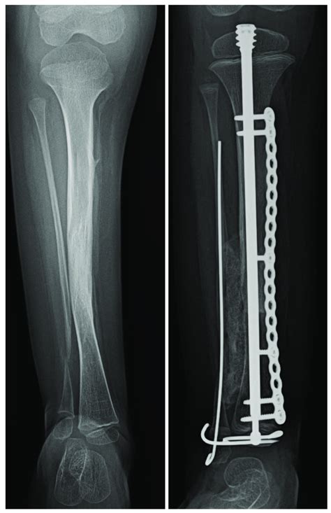 The Image On The Left Demonstrates The Proximal Fibular Migration