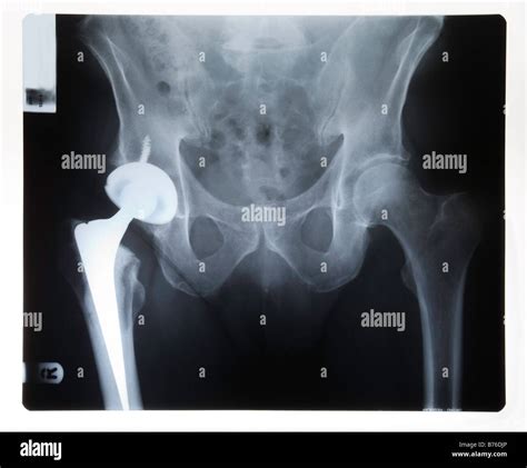 Hip replacement x ray hi-res stock photography and images - Alamy