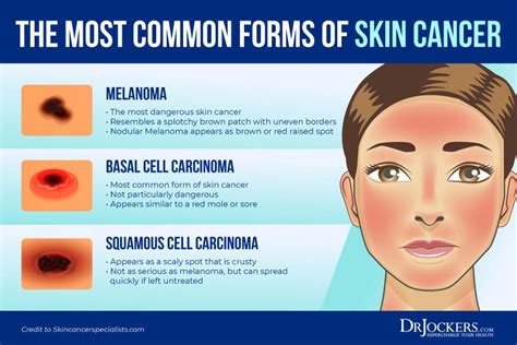 Skin Cancer Symptoms Causes And Natural Support Strategies