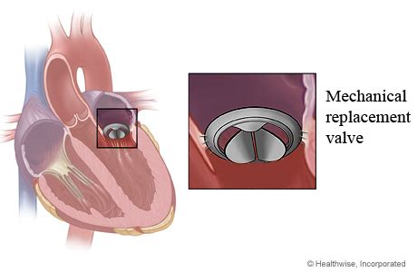 Mechanical Mitral Valve In Heart And Close Up Of Mechanical Replacement