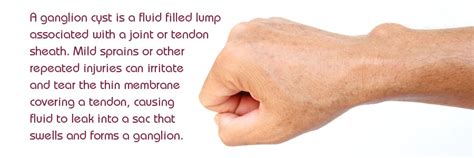 Ganglion Cyst Wrist Causes