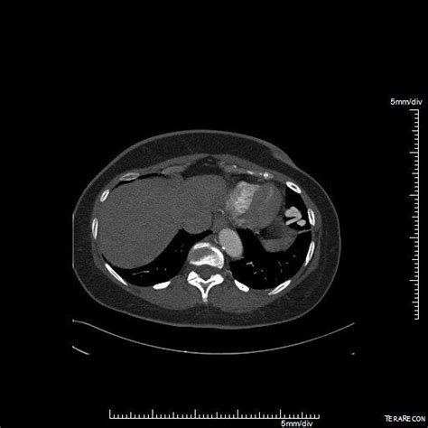 Pulmonary Avm Embolization With Amplatzer Plug Eurorad