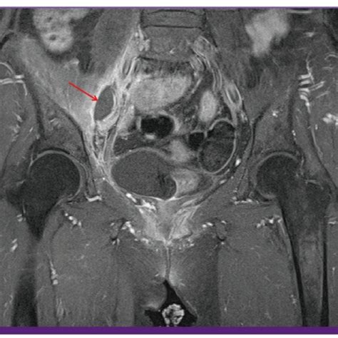 Contrast Enhanced T Weighted Magnetic Resonance Imaging Of Both Hips