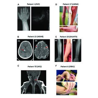 Representative Clinical Findings In Patients With Positive Molecular