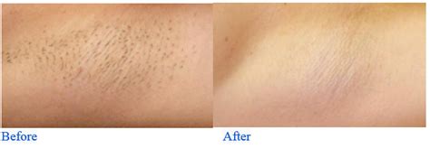 Armpit Laser Hair Removal Radiance Medspa Beauty Bar Toronto