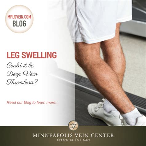 Leg Swelling Could It Be Deep Vein Thrombosis Minneapolis Vein