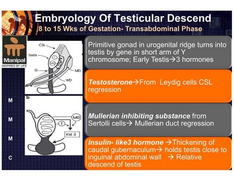 Cryptorchidism Undescended Testis