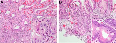 A Gastric Biopsies Taken While The Patient Was Being Treated With Download Scientific Diagram