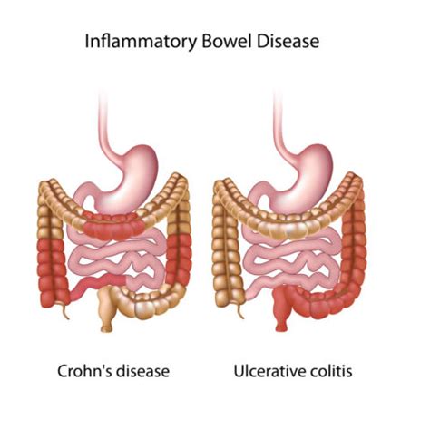 Unc Rex Colorectal Raleigh Inflammatory Bowel Disease Ibd