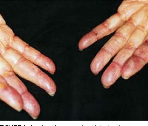 Figure 1 From Gangrene Of The Fingertips After Bleomycin And