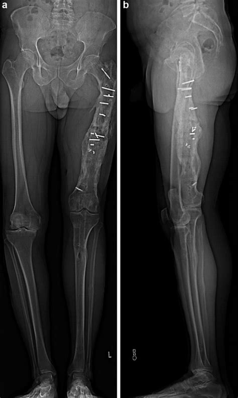 Post Oncologic Allograft Femur Nonunion Treated With Staged Compression