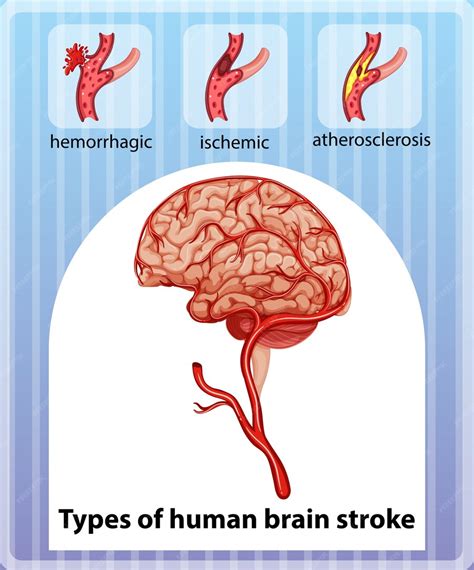 premium vector types  human brain stroke