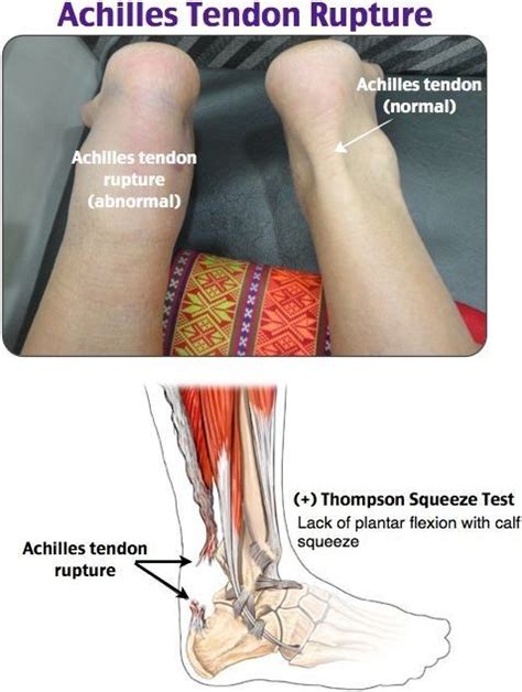 Achilles Tendinopathy And Achilles Tendon Partial And Full Thickness