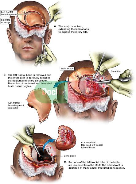 Brain Surgery Partial Left Frontal Lobectomy Doctor Stock