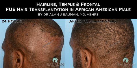 Hair Transplant Scar Black Men