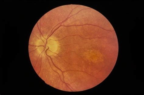 Липофусцин