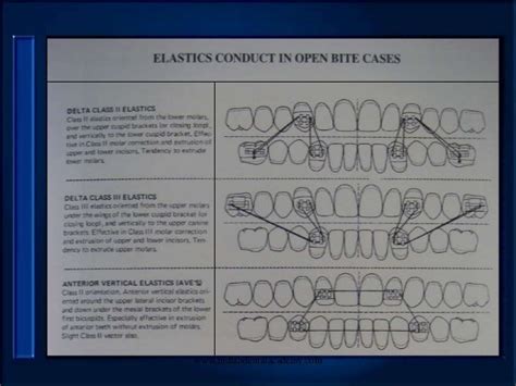 Elastics In Orthodontics Certified Fixed Orthodontic Courses By Indi